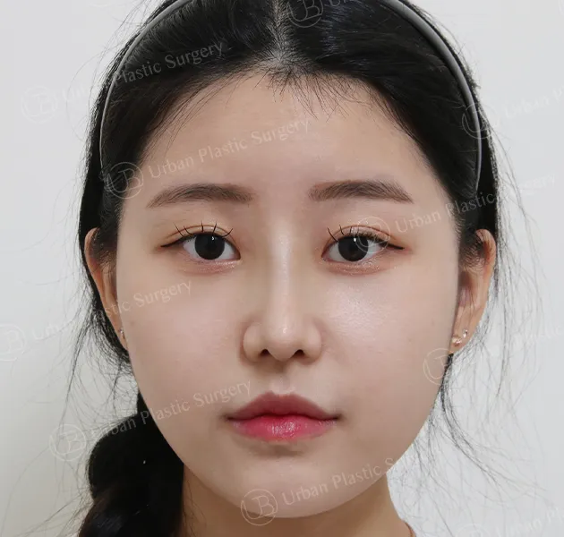 Rhinoplasty, After, Front