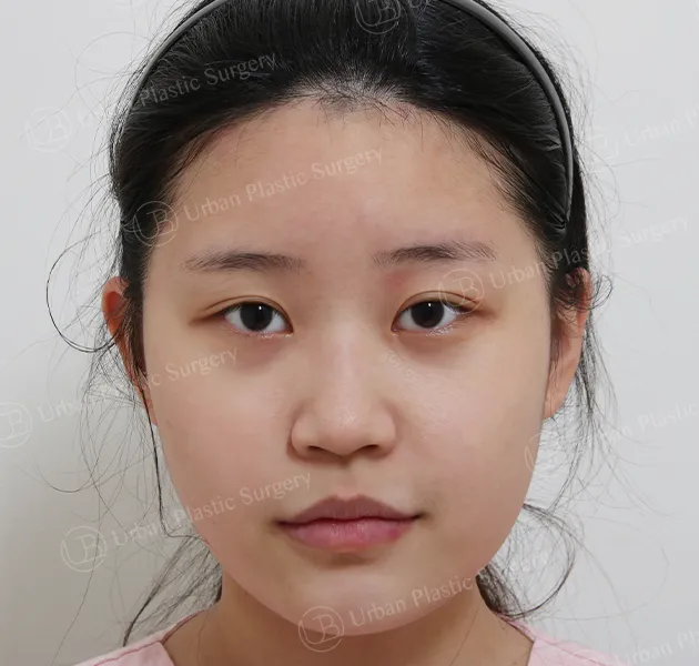 Rhinoplasty, Before, Front