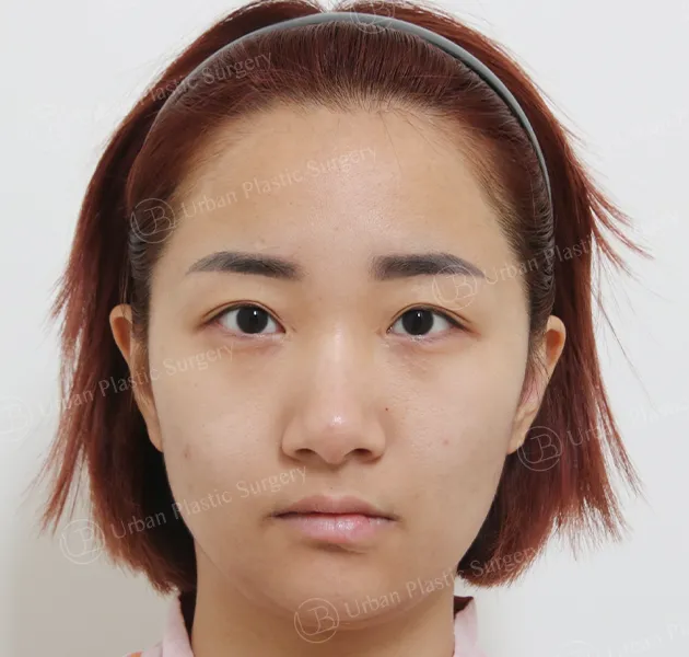 Eye revision, Before, Front