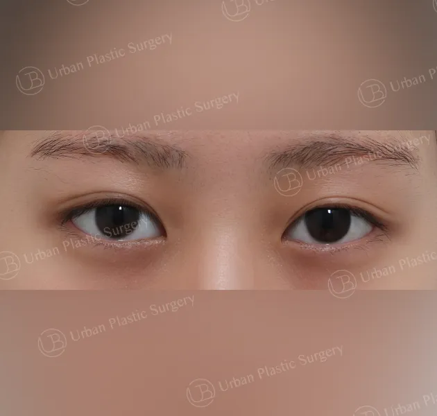 Suture double eyelid, After, Front
