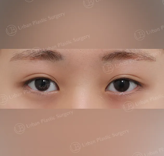 Suture double eyelid, Before, Front
