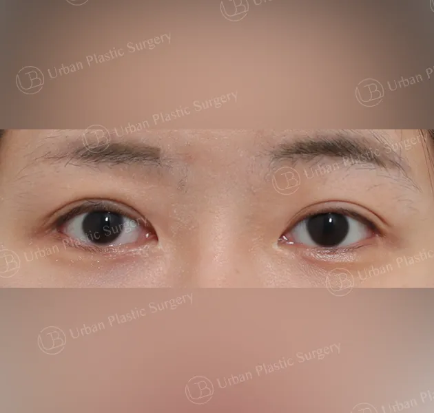 Incisional double eyelid, After, Front