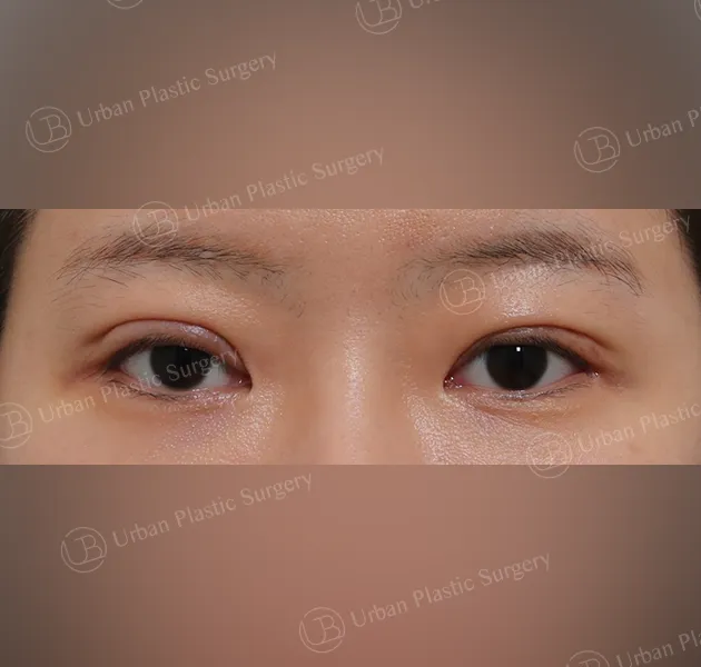 Incisional double eyelid, Before, Front