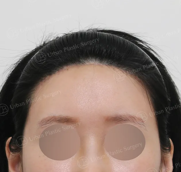 Forehead reduction, After, Front
