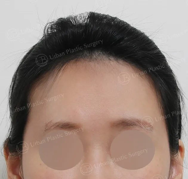 Forehead reduction, Before, Front
