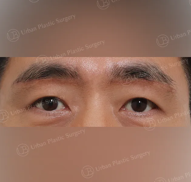 Sub-brow lift, After, Front