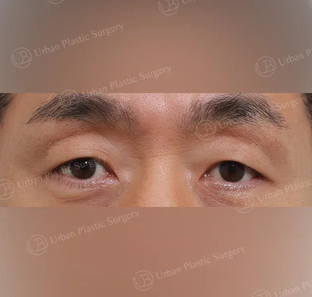 Sub-brow lift, Before, Front