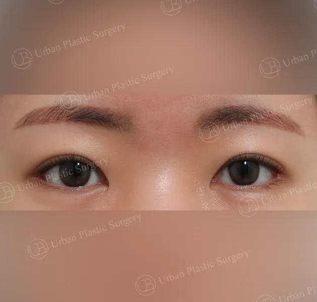 Dual canthoplasty, After, Front