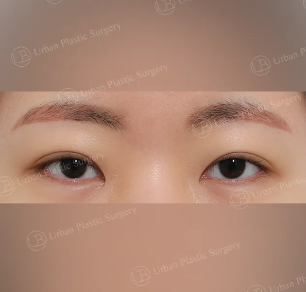 Dual canthoplasty, Before, Front