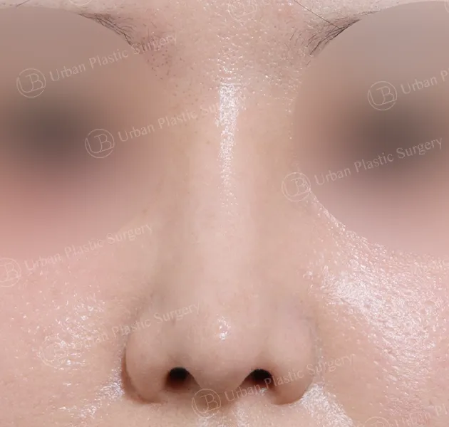 Open rhinoplasty, After, Front