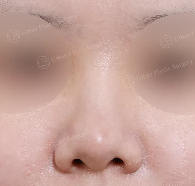 Open rhinoplasty, Before, Front