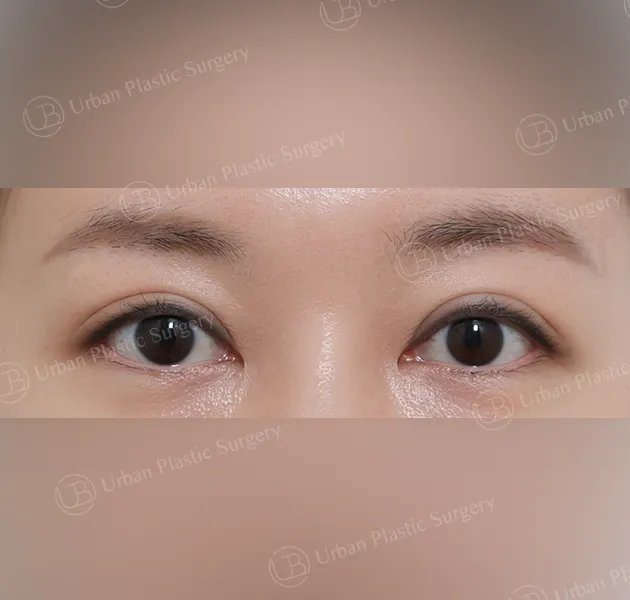 Suture double eyelid, After, Front, Case pfu7X
