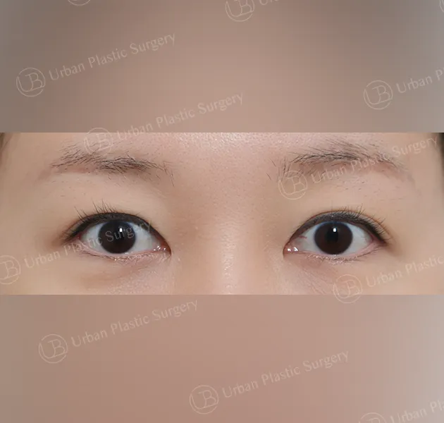Suture double eyelid, Before, Front, Case pfu7X