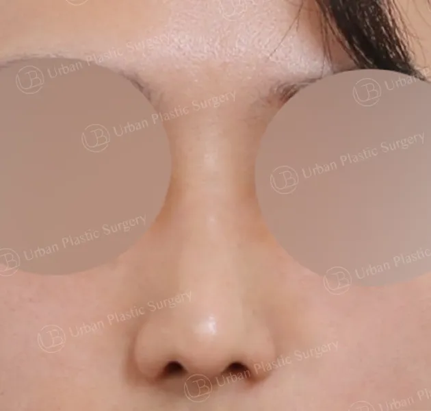 Open rhinoplasty, After, Front