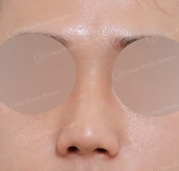 Open rhinoplasty, Before, Front