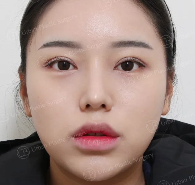 Eye revision, After, Front