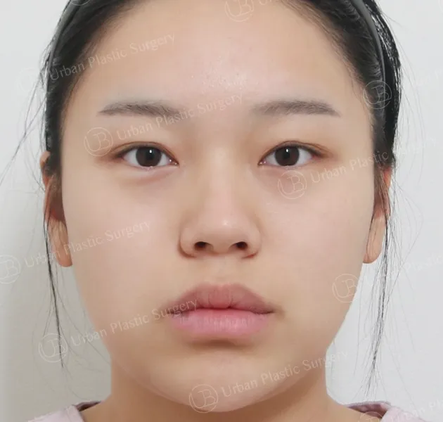 Eye revision, Before, Front