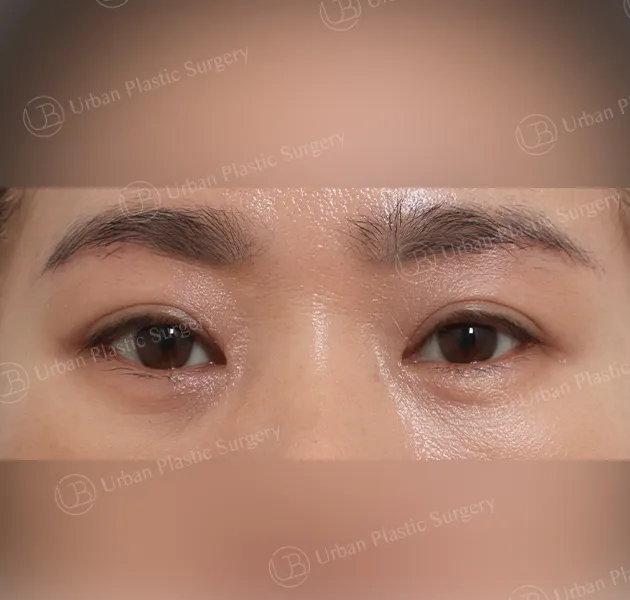 Sub-brow lift, After, Front