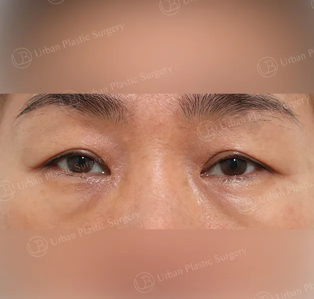 Sub-brow lift, Before, Front