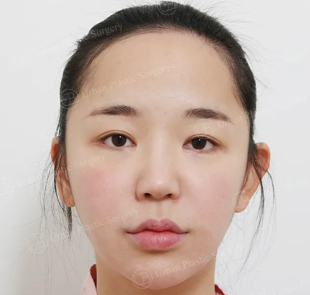 額頭縮小，術前，正面，案例 ssjEP