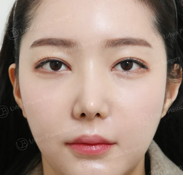 Nose revision, After, Front, Case tPicD
