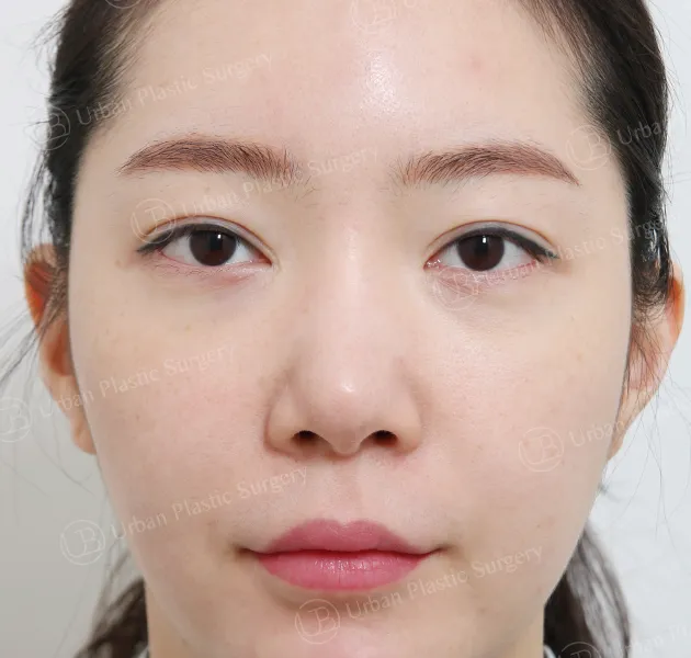Nose revision, Before, Front, Case tPicD