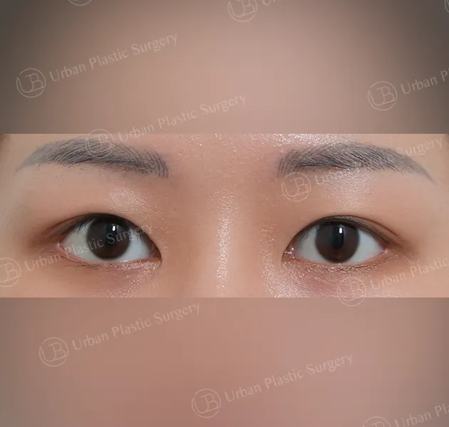 Incisional double eyelid, After, Front