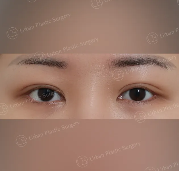 Incisional double eyelid, Before, Front