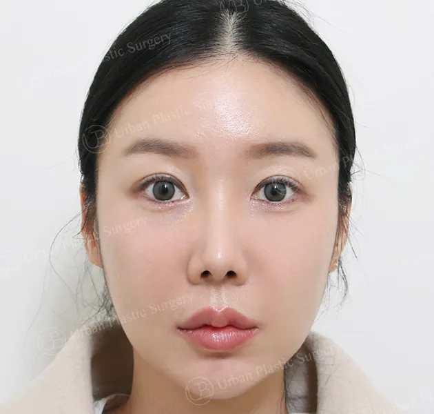 Eye revision, After, Front