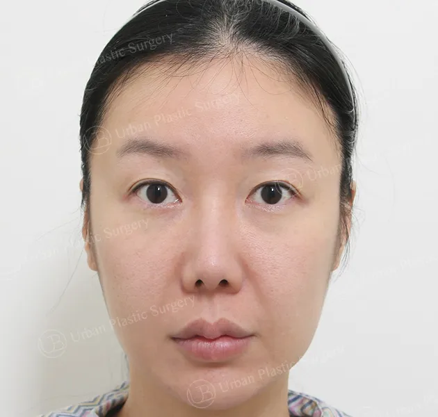 Eye revision, Before, Front