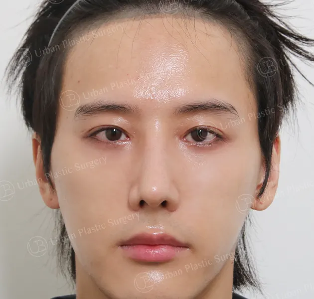Open rhinoplasty, After, Front, Case wEtdo
