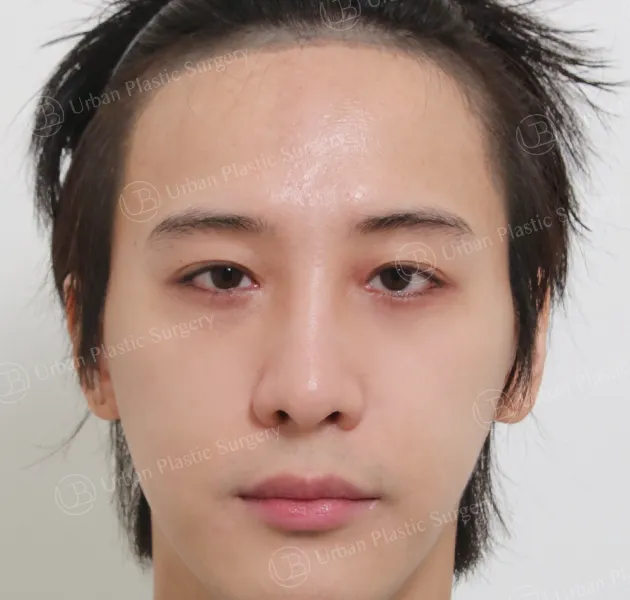 Open rhinoplasty, Before, Front, Case wEtdo