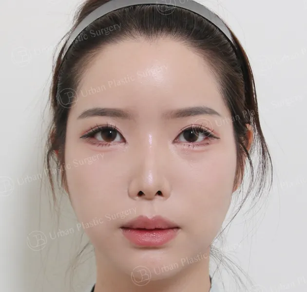 Eye revision, After, Front