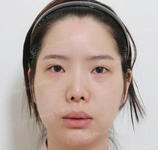 Eye revision, Before, Front