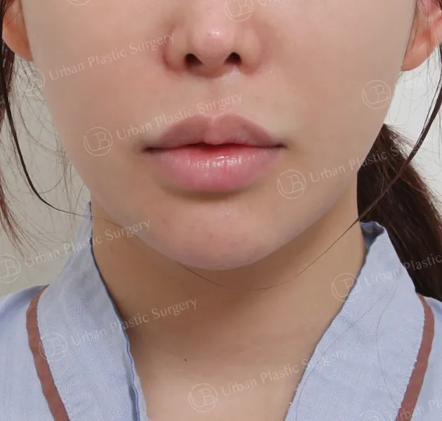 Philtrum shortening revision, Before, Front