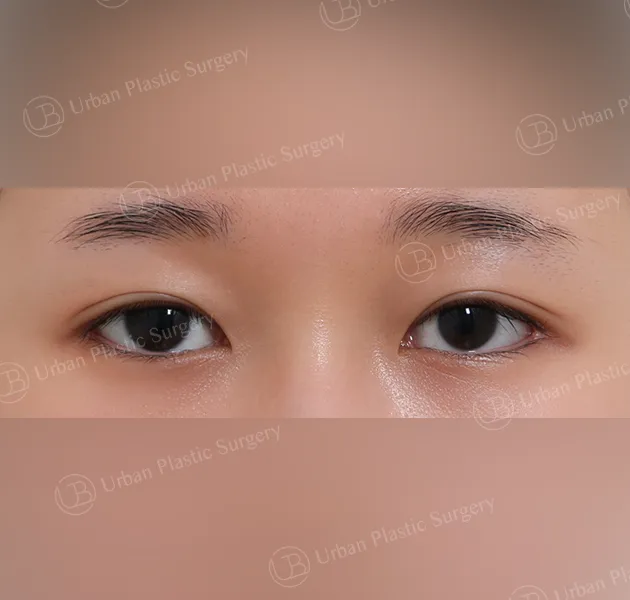 Suture double eyelid, After, Front, Case zMgG2
