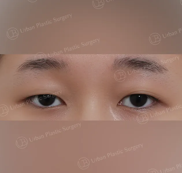 Suture double eyelid, Before, Front, Case zMgG2