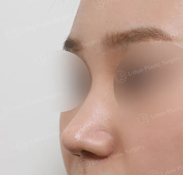 Implant-free rhinoplasty, After, 45°