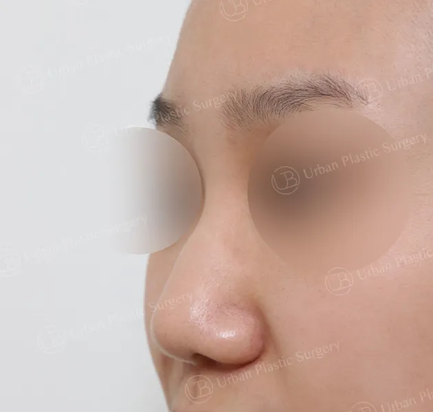 Implant-free rhinoplasty, Before, 45°
