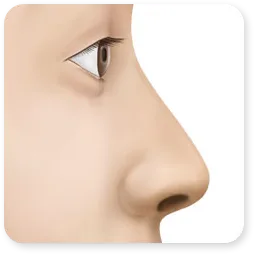 ภาพวาดด้านข้างของคลินิก แสดงจมูกที่สันจมูกต่ำก่อนผ่าตัด