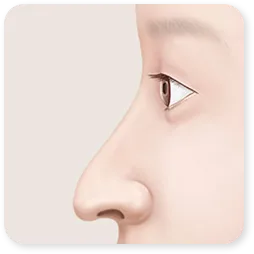ภาพวาดด้านข้างของคลินิกแสดงจมูกยาวที่ปลายจมูกห้อยลง ก่อนผ่าตัด