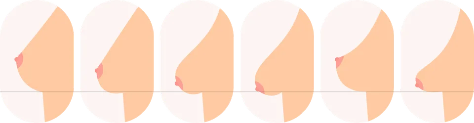 Hình minh họa của phòng khám cho phần tự đánh giá ngực chảy xệ.