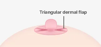 Hình vẽ của phòng khám về các vạt trung bì hình tam giác ở hai bên núm vú.