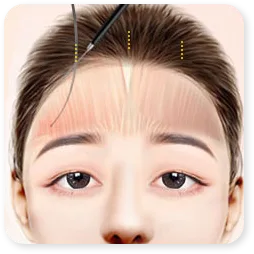Gambar Step 02 klinik bagi angkat dahi secara endoskopik.