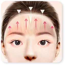 Gambar Step 03 klinik bagi angkat dahi secara endoskopik.