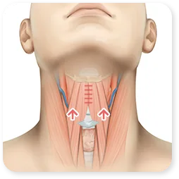 Gambar Step 03 dari klinik, untuk sayatan melintang di bagian bawah otot leher.