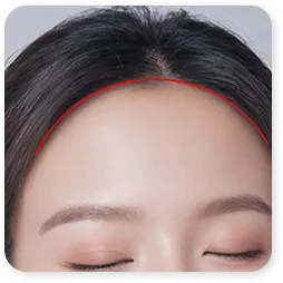 クリニックの額縮小術の手順1の図。おでこ側の生え際に沿った切開が描かれている。