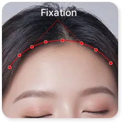 クリニックの額縮小術の手順3の図。皮弁が固定され、切開が縫い合わされている。