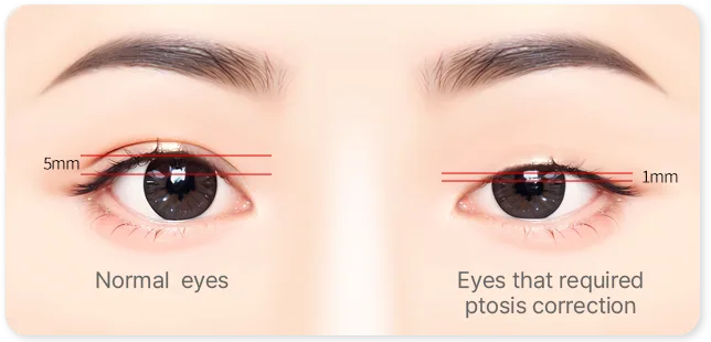Lukisan 2 mata terbuka. Di kiri, berlabel Normal eyes, terdapat 2 garisan merah yang berjarak 5mm. Di kanan, berlabel Eyes that required ptosis correction, kelopak mata berada lebih rendah di atas iris dan garisannya ditanda 1mm.