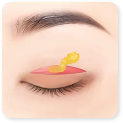 Gambar langkah 2 dari klinik: kulit, otot, atau lemak berlebih sedang dibuang dari kelopak atas.